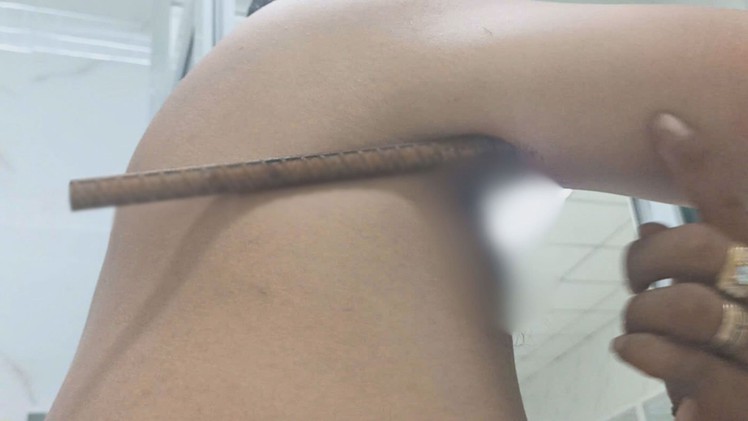 Góc nhìn trưa nay: Nam thanh niên bị thanh sắt đâm xuyên cánh tay; Xe 15 chỗ nhồi nhét 37 người bị phạt nặng