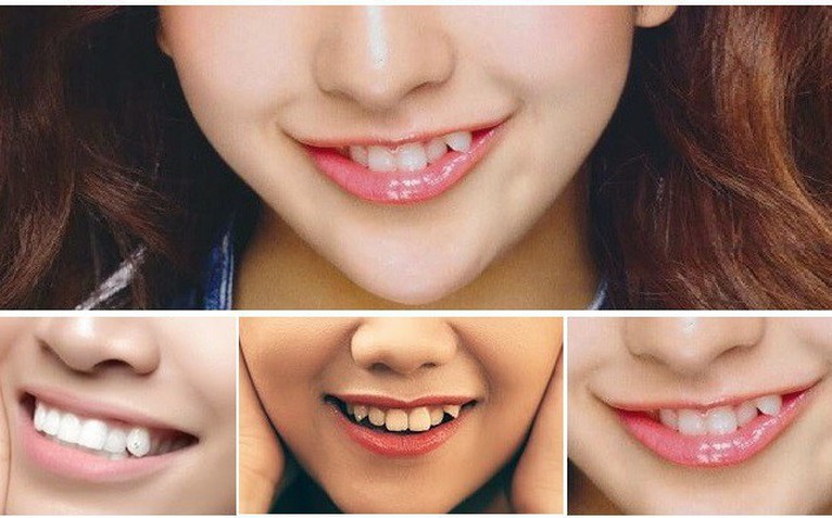 Làm răng khểnh thẩm mỹ để nụ cười thêm xinh được không?