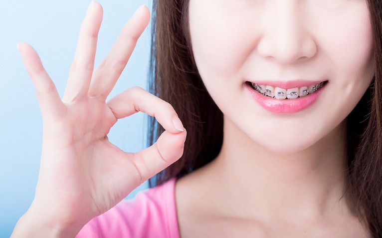 Phương pháp niềng răng phù hợp cho tuổi thanh, thiếu niên